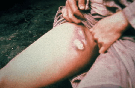 흑사병으로 인한 림프 부종