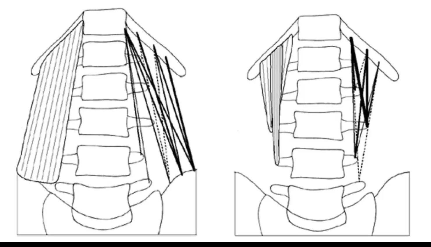 요방형근(quadratus lumborum)의 숨겨진 비밀: 해부학적 구조와 기능의 새로운 발견