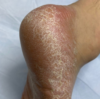 발 각질 간단하게 제거하는법