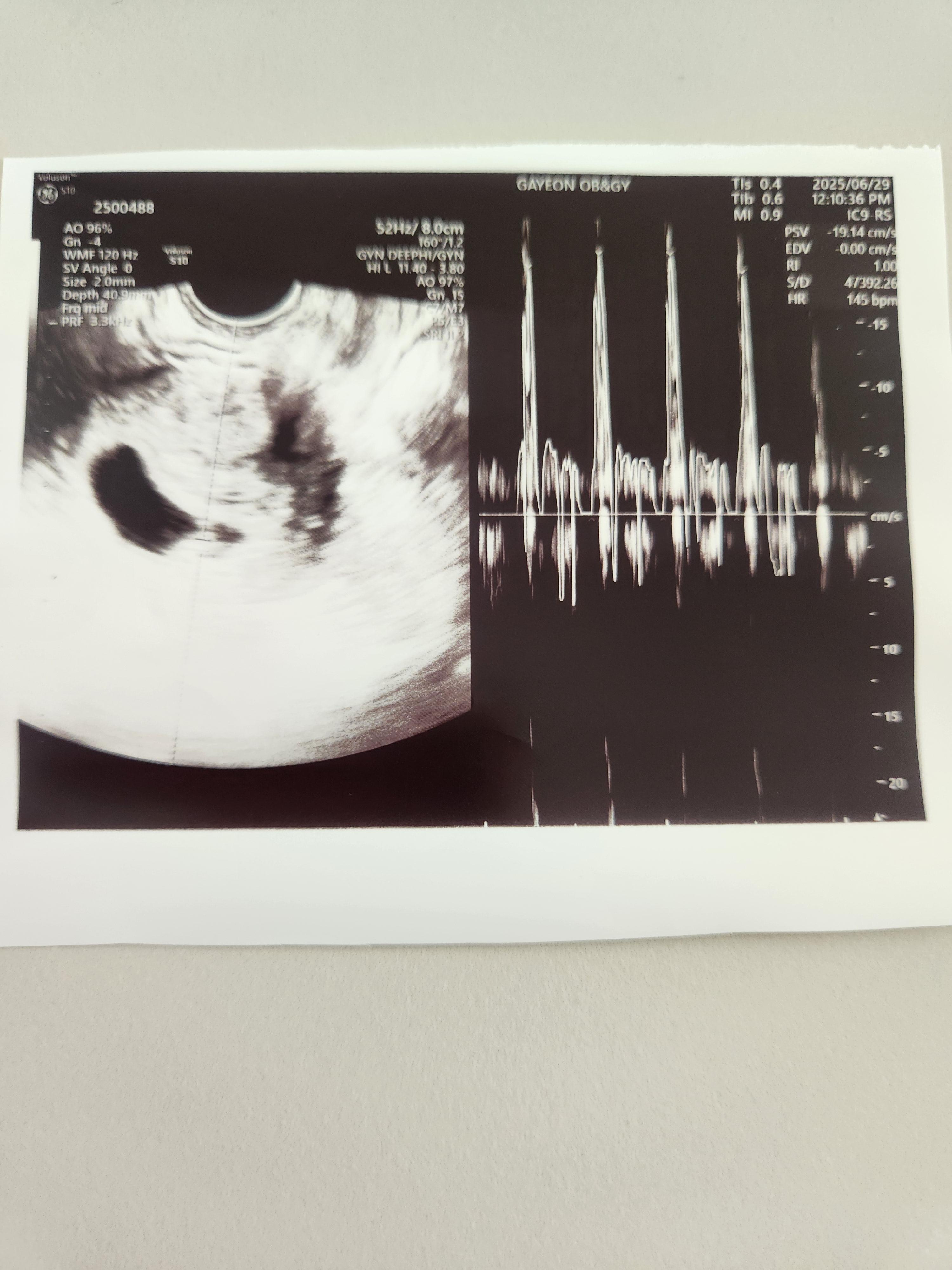 임신 6주차, 6주4일차 초음파