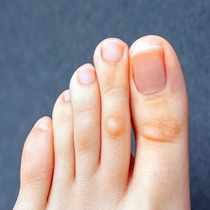 티눈 없애는 방법