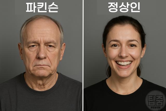 치매 파킨슨병 초기증상 표정