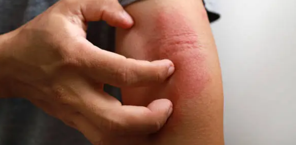 아토피 관련 사진