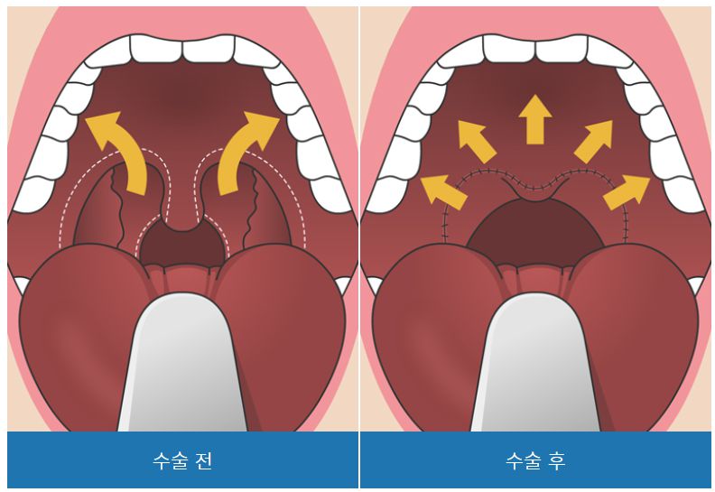 코골이수술