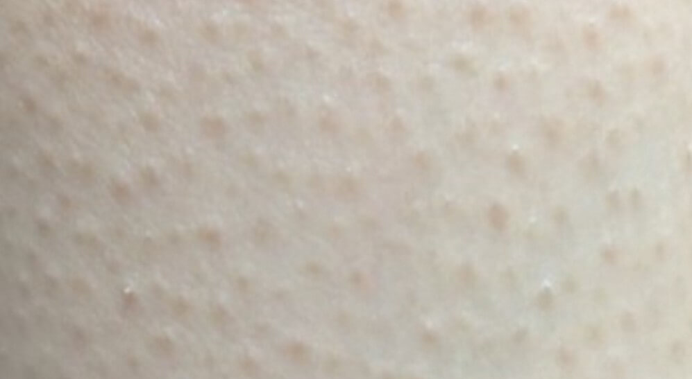 모공각화증 피부 증상