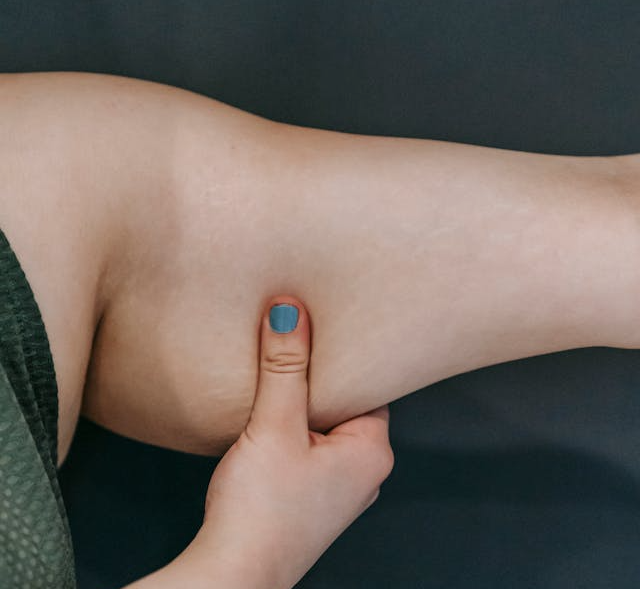 살빼기 시 고민되는 셀룰라이트란 무엇인가? 단순 지방이 아닌 '병든 살'의 정체