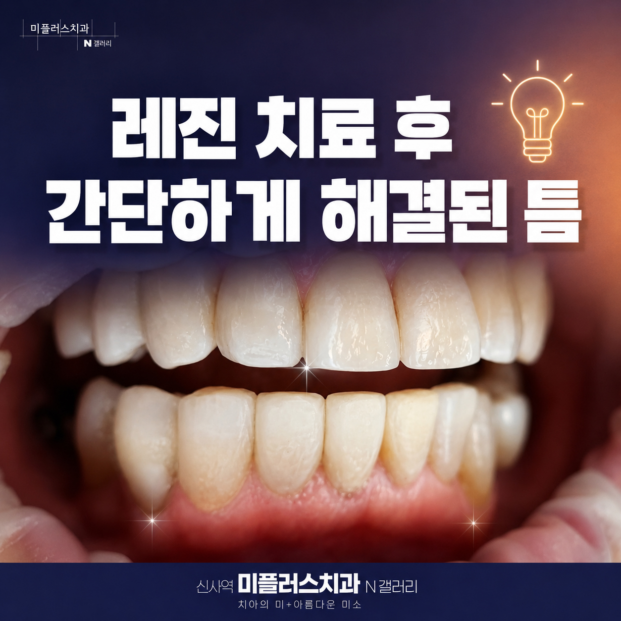 레진 치료로 블랙트라이앵글을 자연스럽게 개선한 치료 후 모습