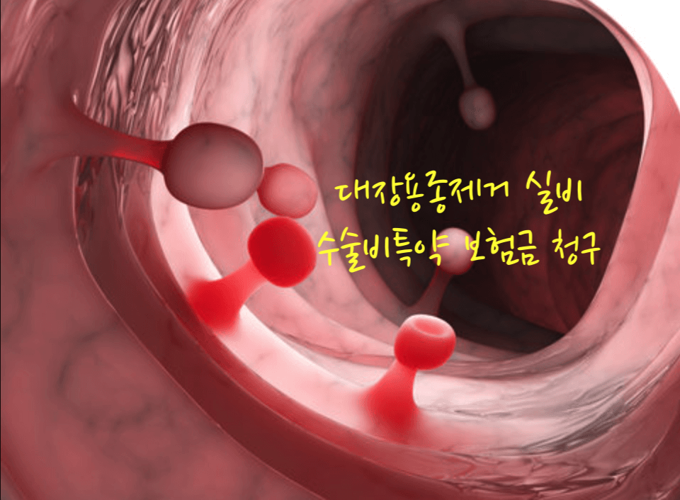 대장용종제거