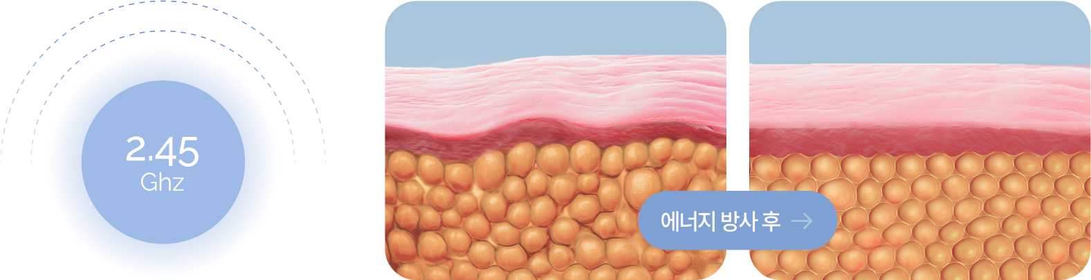 극초단파 리프팅이 콜라겐에 미치는 영향