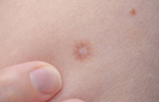 쥐젖 제거방법, 쥐젖이 생기는 이유, 제거 연고 총정리 (2024ver)