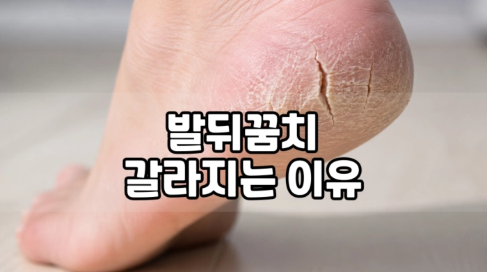 발뒤꿈치 갈라지는 이유