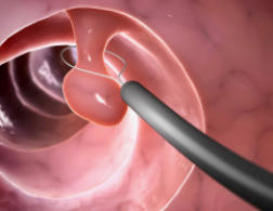 용종제거-사진3