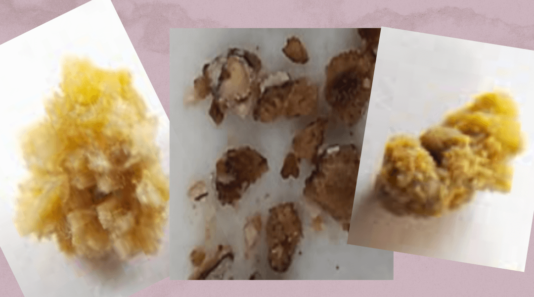 신장결석, 요로결석