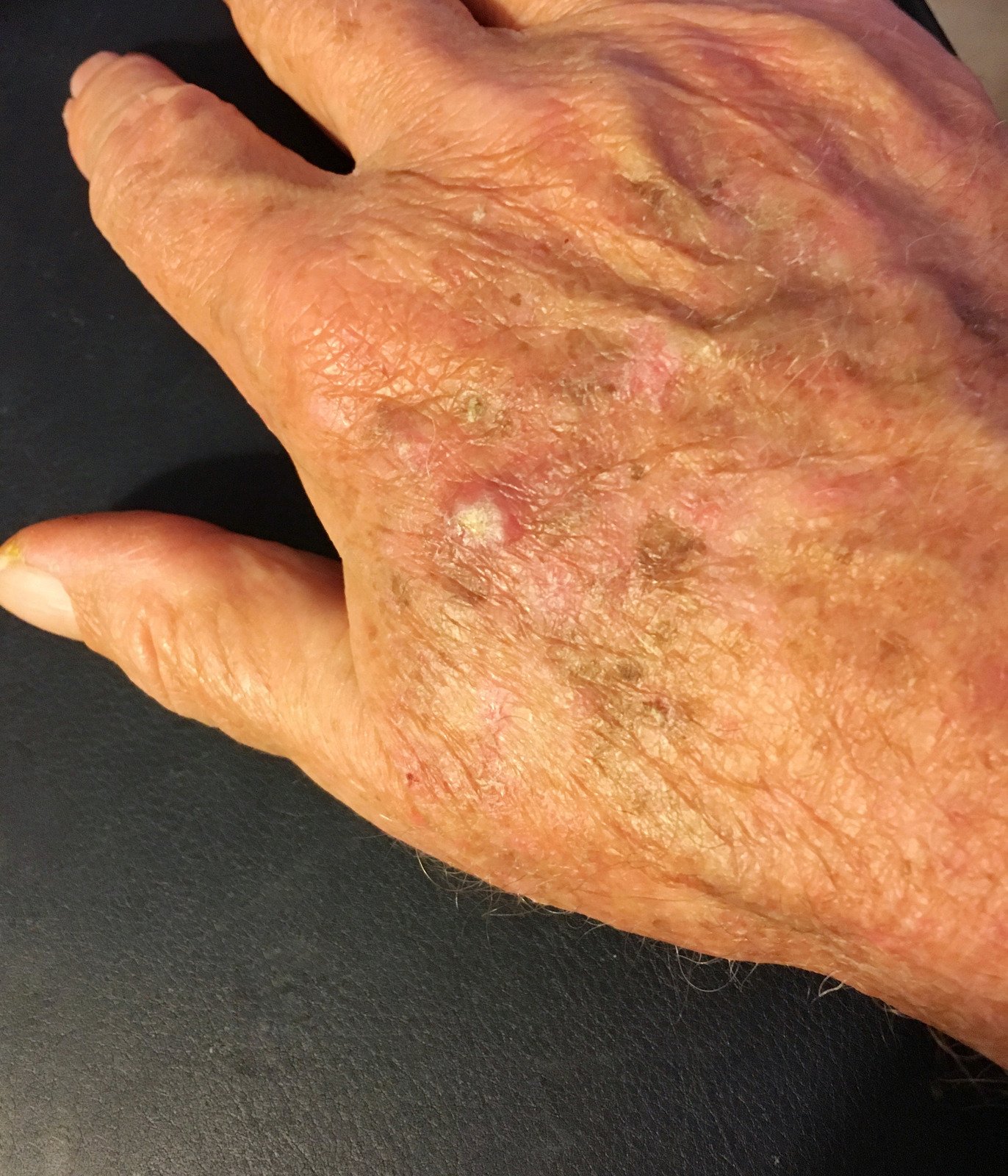 광선각화증 (Actinic Keratosis)의 원인과 치료