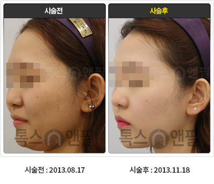 옆광대축소주사