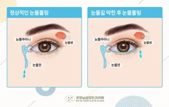 눈물샘 뚫는 수술 간단한가요에 대한 수술정보_5