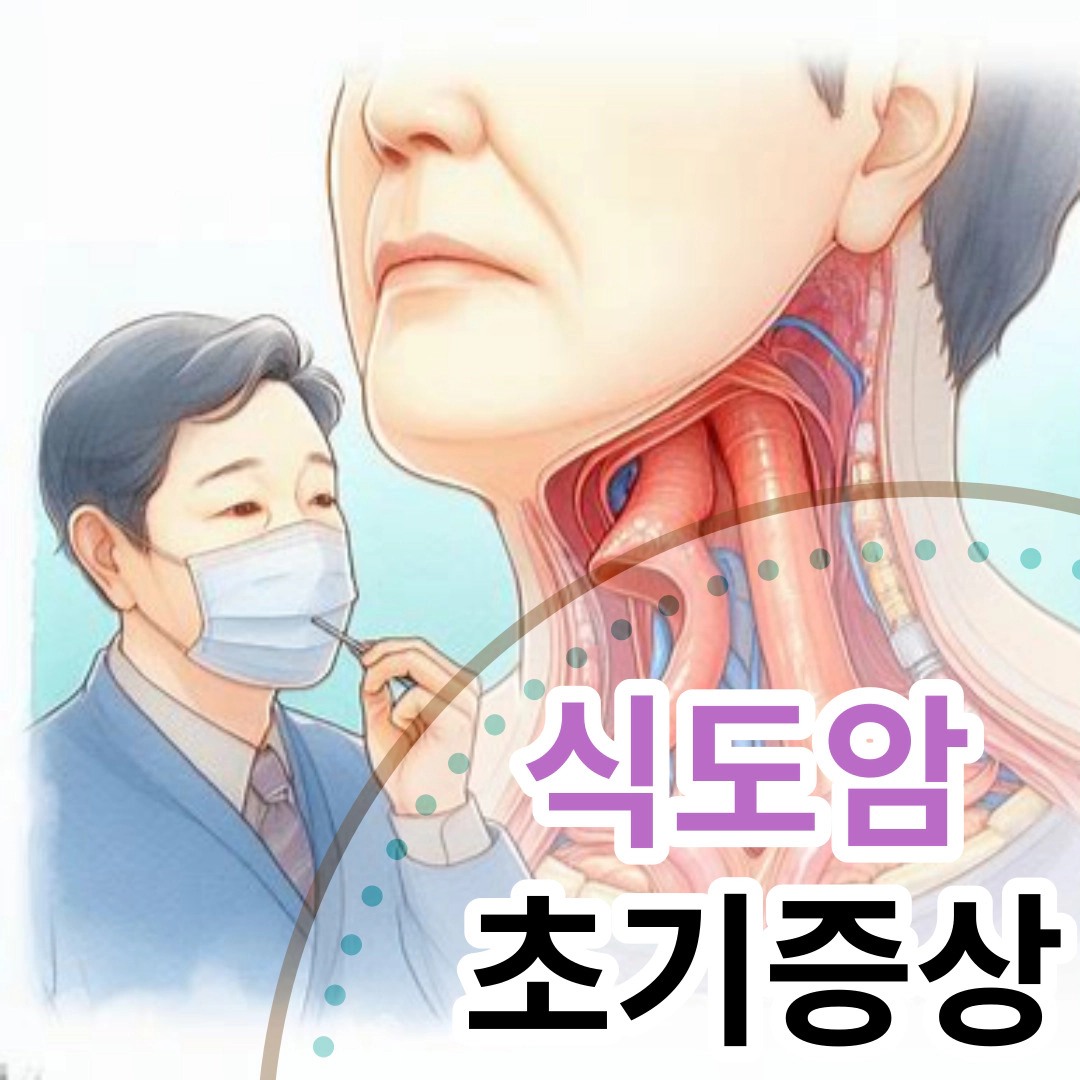 식도암 초기증상-증상