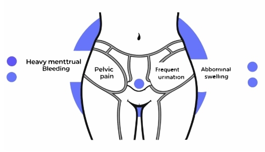 자궁근종 원인과 의심증상