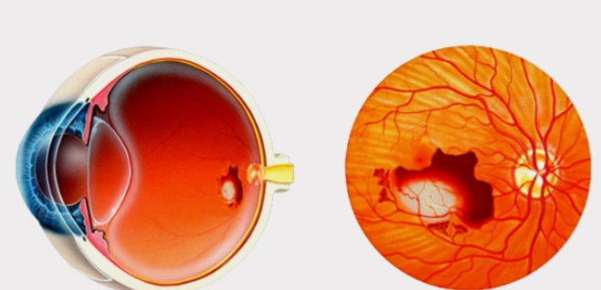 시니어 루테인 효과 5가지, 의사도 권하는 눈 영양제는?