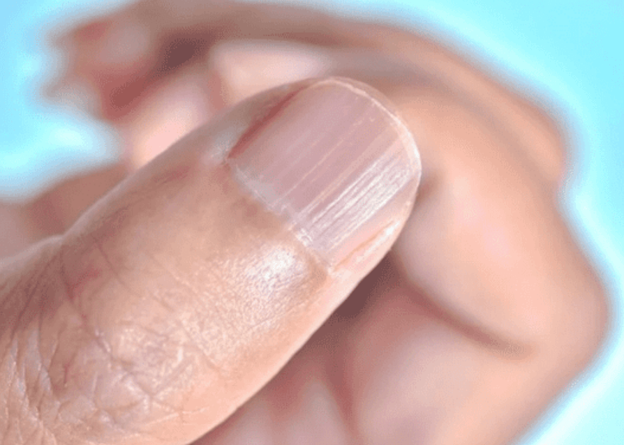 손톱 세로줄 원인