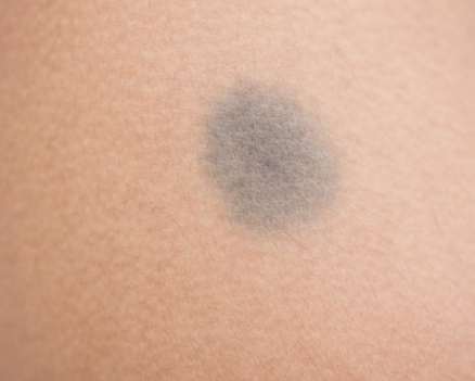 아기 얼굴 몽고반점, 걱정되시죠?