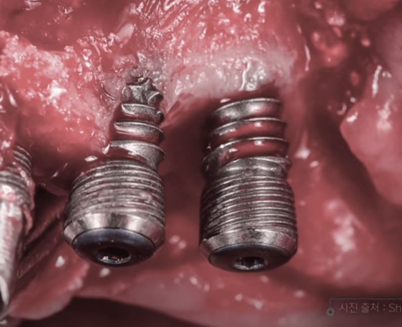 임플란트 주위염 ; 증상, 원인, 예방 및 관리방법 알아보기(재수술, 부작용, 재식립)