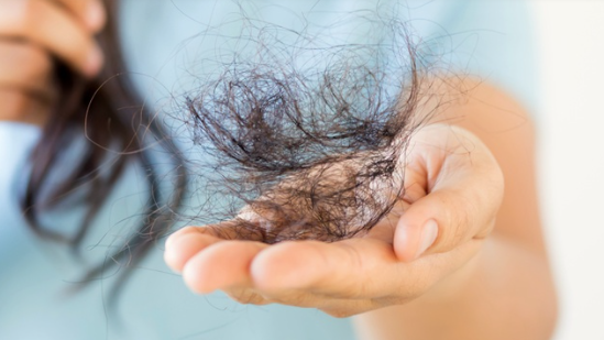 호르몬에 의한 여성탈모