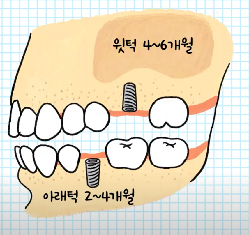 잇몸뼈와 임플란트 결합 소요시긴