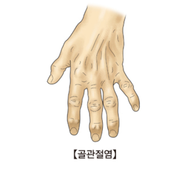 관절염의종류