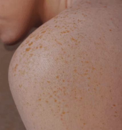 봉와직염 증상 - 청결 유지