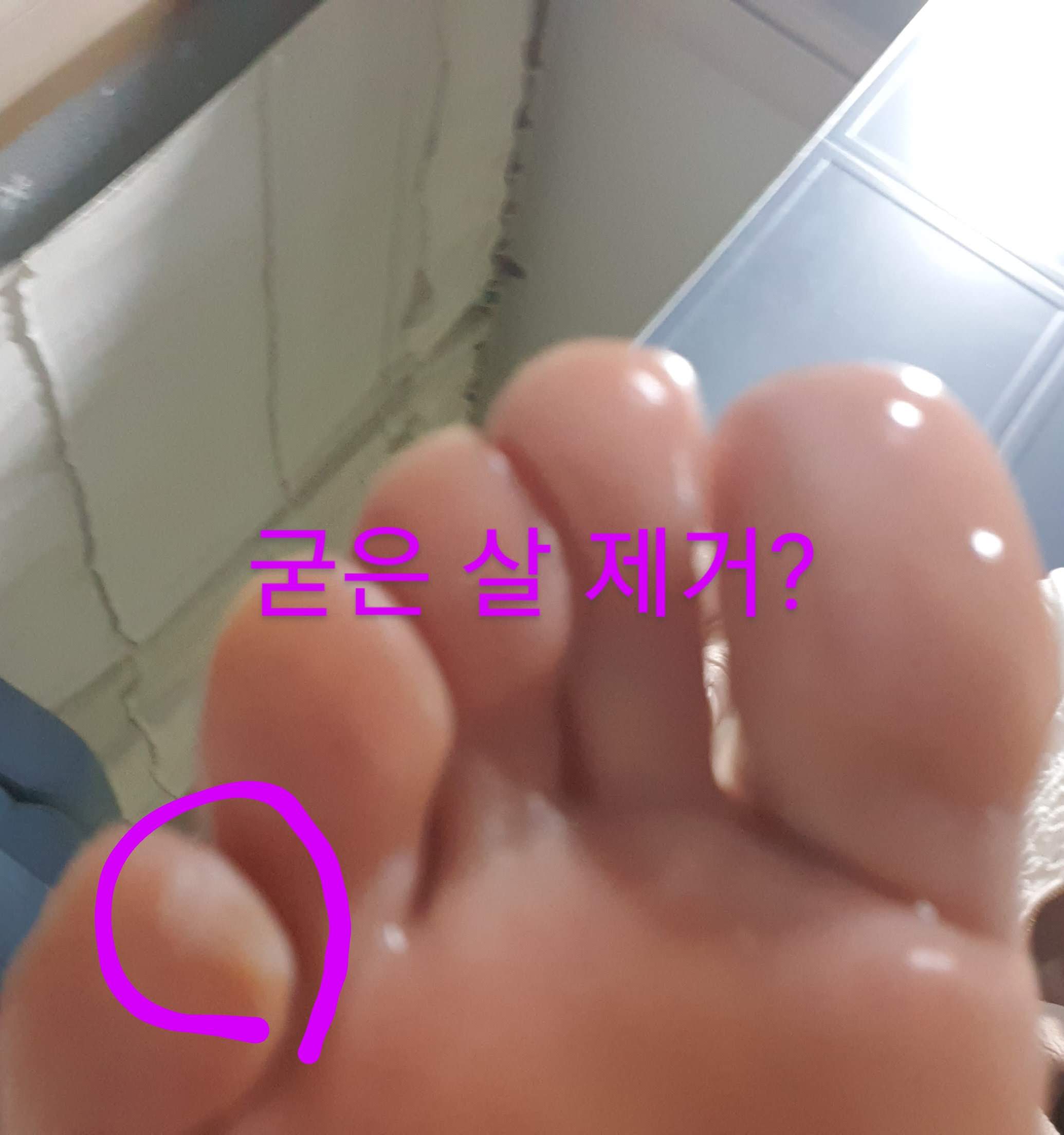 굳은 살 제거