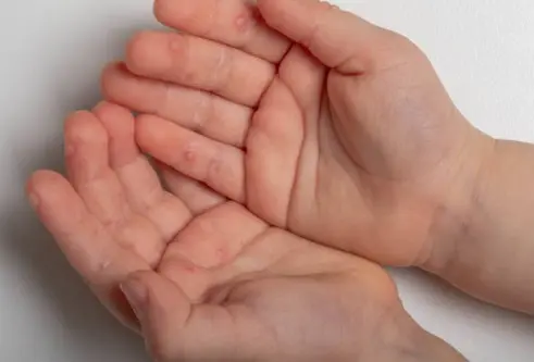 수족구 증상