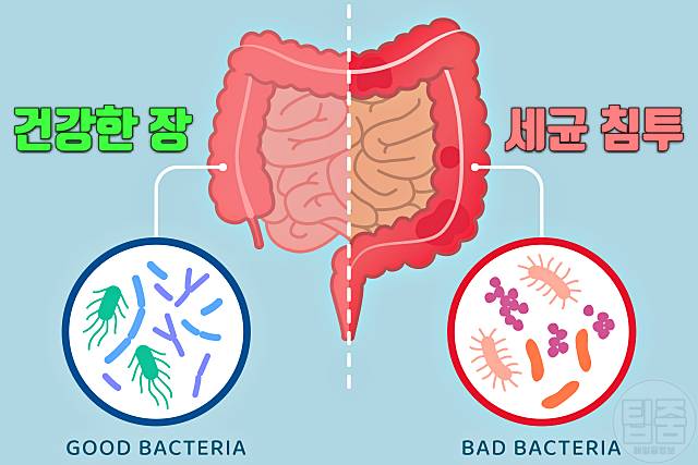 장염 걸리는 이유 장염 원인 장내 미생물 불균형