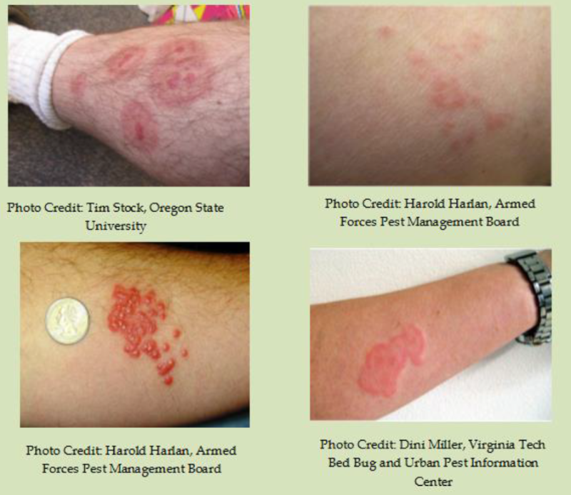 빈대 물린 자국이 난 팔과 다리