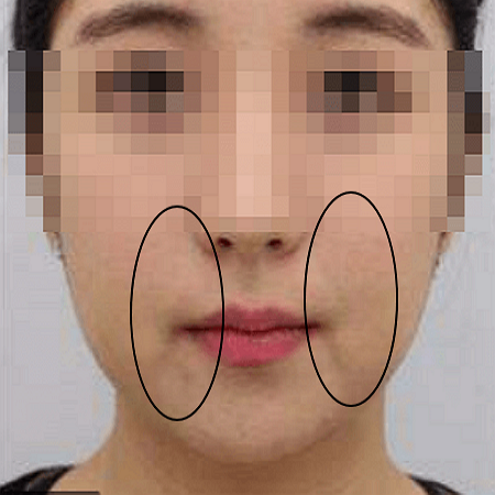 올리지오-리프팅-하기-전-사진