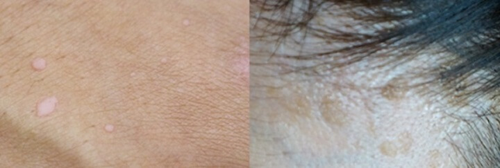 바이러스-활성-비활성-상태(편평사마귀-제거-가격-비용)