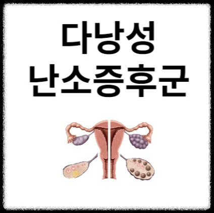 다낭성난소증후군, 왜 난임의 원인이 될까?