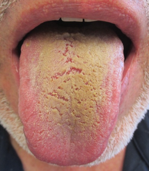 모설(hairy tongue)의 사진