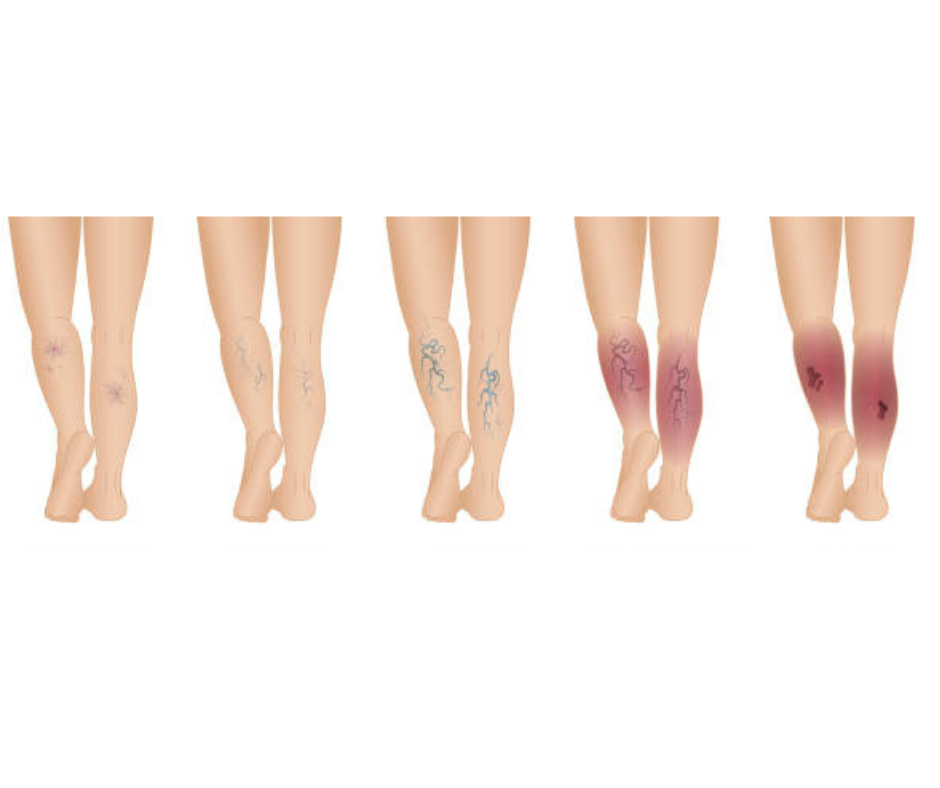 하지정맥류 증상