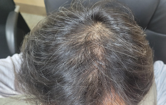 발모약을 복용한 후 대략 1년 6개월이 지난 정수리부의 머리카락 상태(2023년 봄의 모발상태)