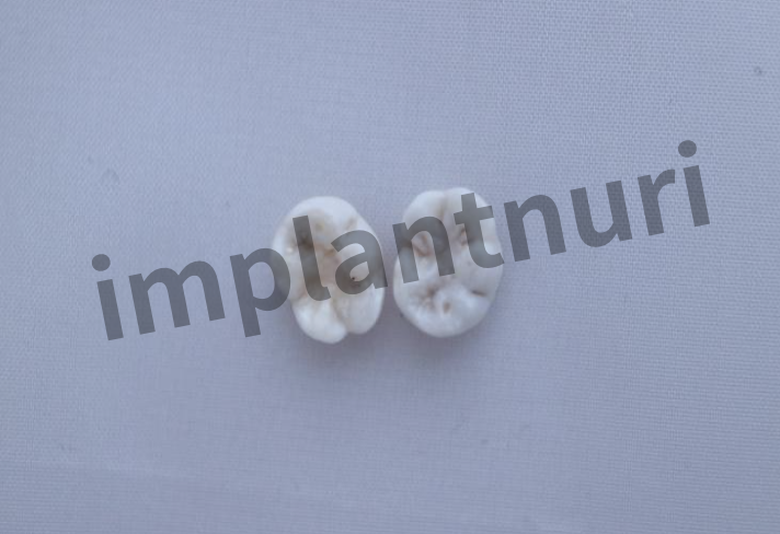 매복 사랑니 발치 비용