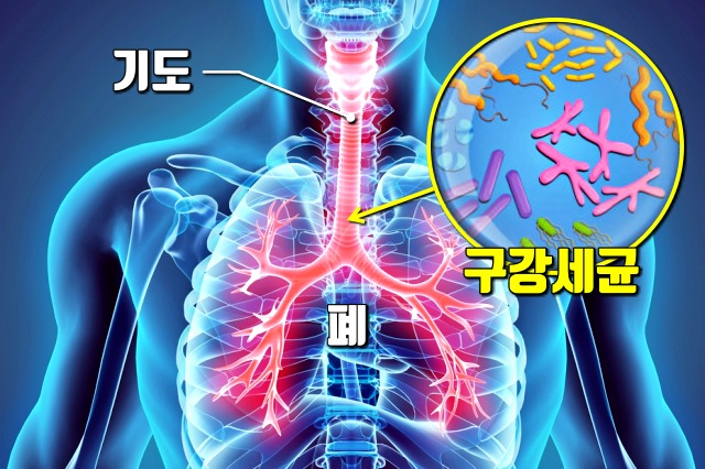 이가 시릴때 폐렴,잇몸병,치주염,풍치,건강,팁줌 매일꿀정보