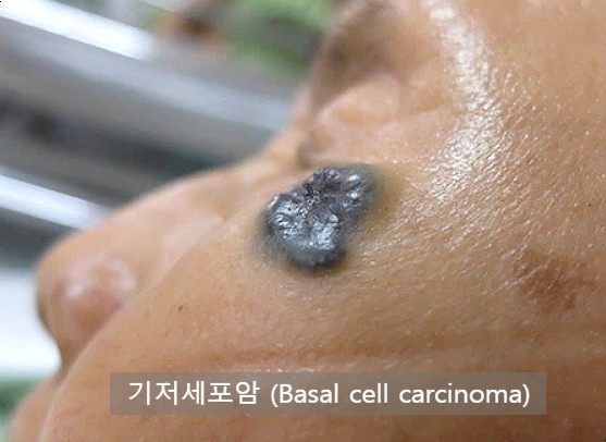 기저세포암
