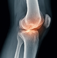 관절염에 좋은 음식