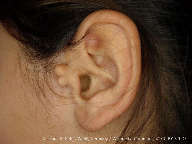 귀 건강 돌기 신장