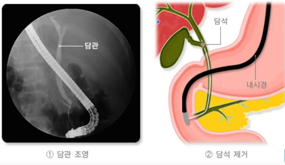 담석증-담관조명-담서제거-이미지
