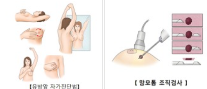 명의 유방암 증상 검사 명의추천