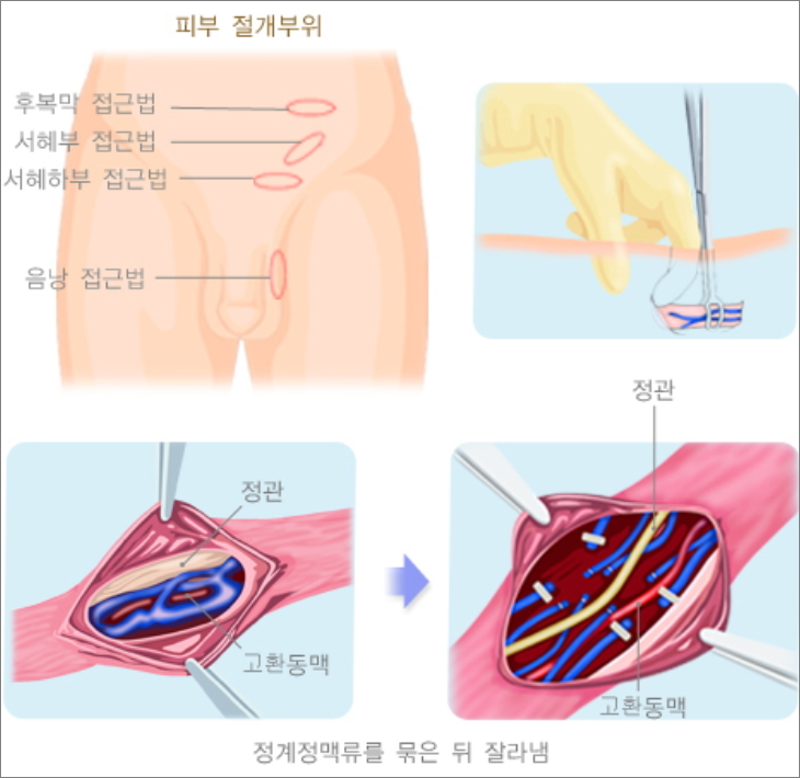 정계정맥류의 수술적 치료법