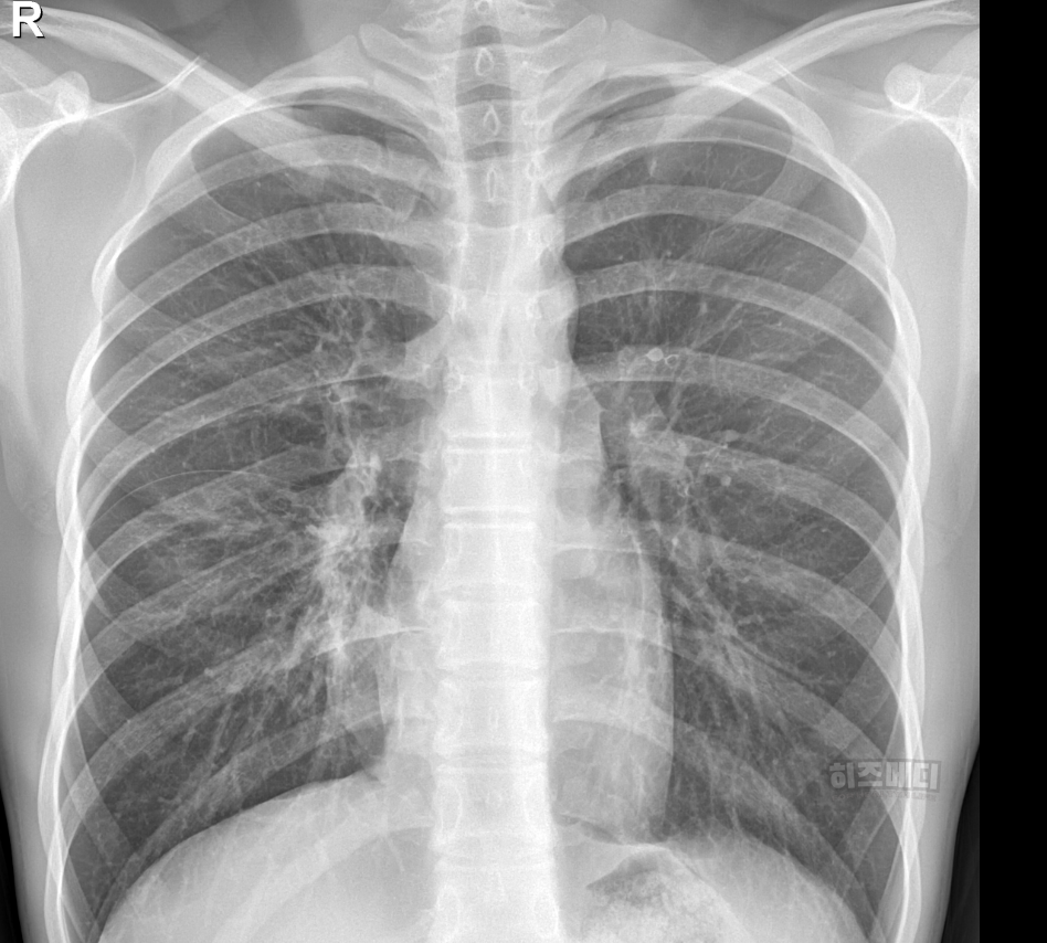 마이코플라스마 폐렴 전염 증상