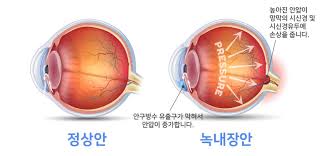 안압상승과 관련된 녹내장 위험군의 상태